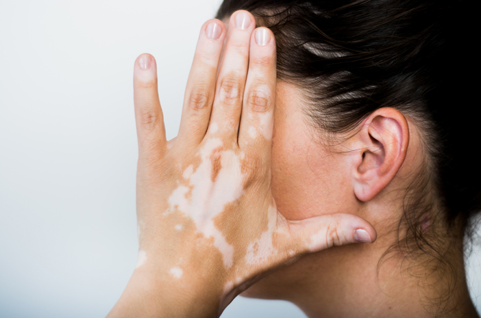 vitiligo